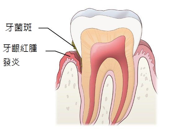 牙齦萎縮原來是牙周病造成？牙醫師教您如何對抗牙周病！