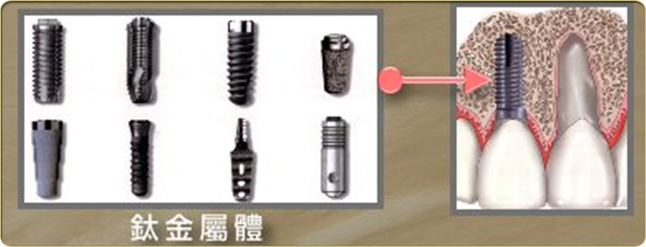 人工植牙 - 鈦金屬體
