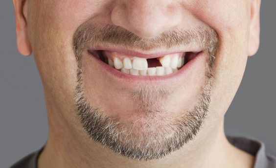 植牙好嗎? 缺牙要植牙還是做假牙? 植牙權威-世樺牙醫師告訴你治療缺牙的3種方式！